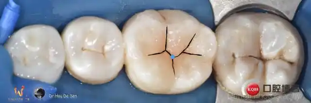 下颌第一磨牙形态逐步恢复