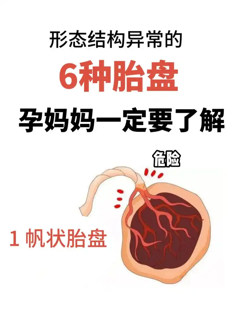 孕期日记‖球拍状胎盘-帆状胎盘-副胎盘.看到论坛站友分享了一 - 抖音