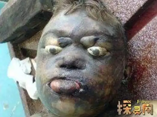 腐败巨人观恶心至极人死后尸体会不断膨胀巨大化如同气球