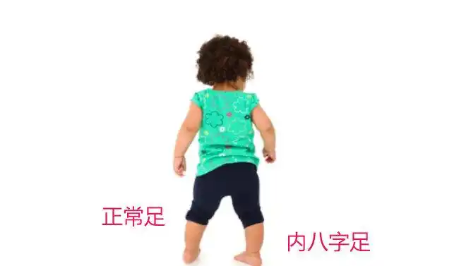 儿童内八字足的奥秘_先天性足畸形 - 好大夫在线