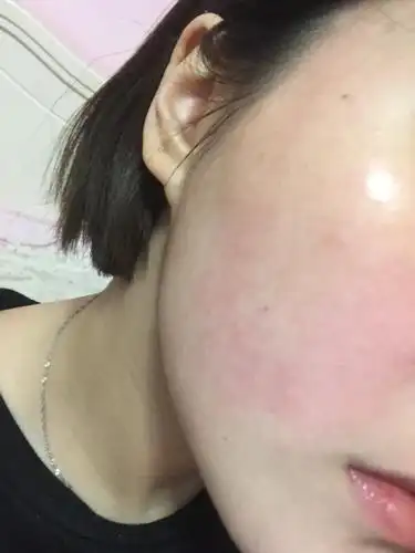 然后一用化学成分多的面膜护肤品就会立刻长红包 有时候脸上老是莫