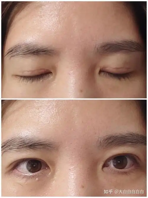 三点定位重睑术恢复过程记录