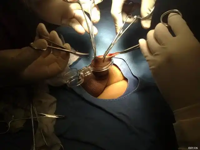 【进展】包皮套扎全过程高清图片