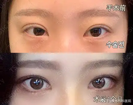 进行香肠眼肉条眼修复手术时不能做上睑提肌的手术