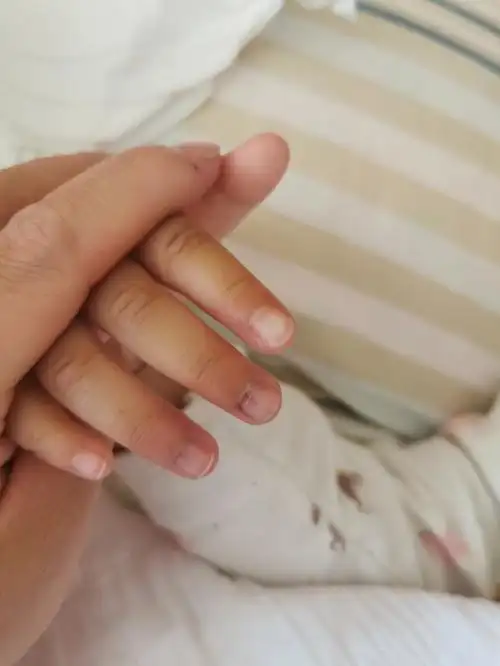 今天宝贝的手被车门夹到,这样会不会起瘀血,或者换指甲呀,已经用冷水