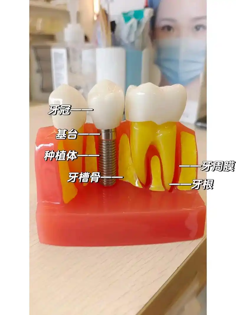 种植牙分为三个步骤称为一期二期三期,分别是 - 抖音
