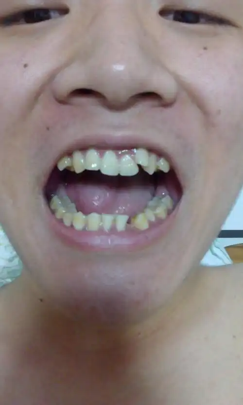 22岁 抽烟牙齿很黄小时候又长了个龅牙 下面牙齿掉了没长 请问去看牙