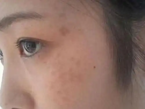 眼角长斑怎么原因
