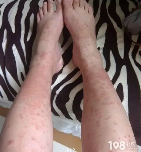 怀孕6个月了, 我身上长满斑啊纹啊 ,吓死