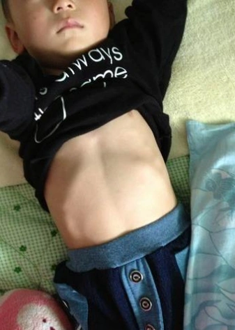 儿童佝偻病症状图片 (23)_有来医生