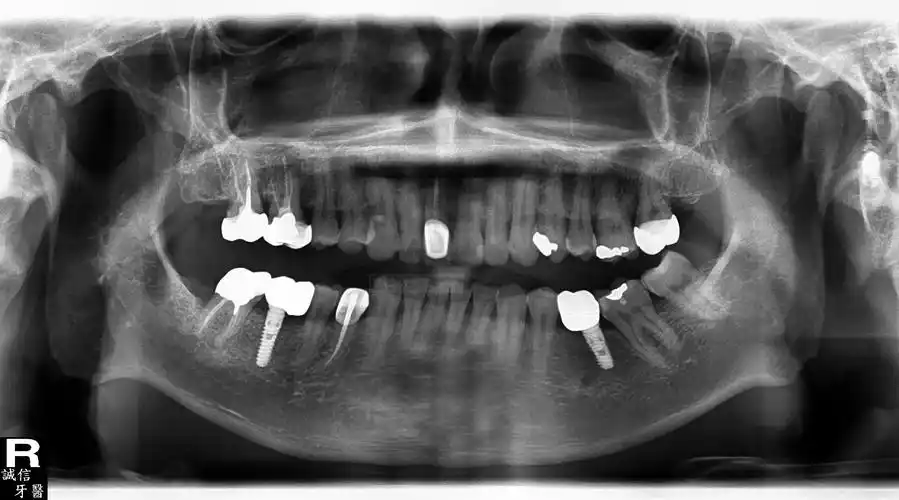 即拔即种植牙实例 请点我