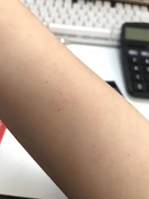 这是什么呀 红色血点点 不知道什么时候有的 没有感觉 不痛不痒