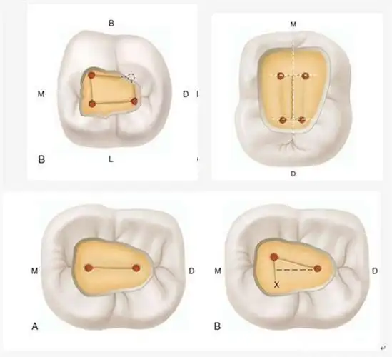 【原创博客】根管治疗的那些事儿(上)--李望松|牙