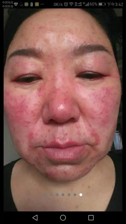 面部皮炎的种类及一般处理