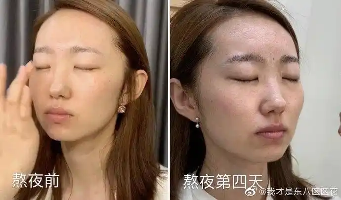 现身说法奉劝各位少熬夜,皮肤真的会变差,真的会显老真的很恐怖