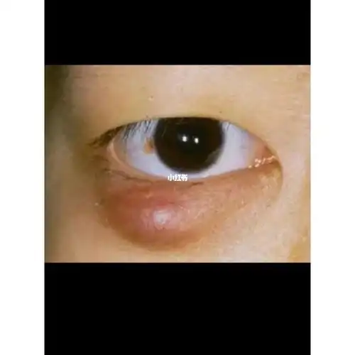 麦粒肿脾胃有火