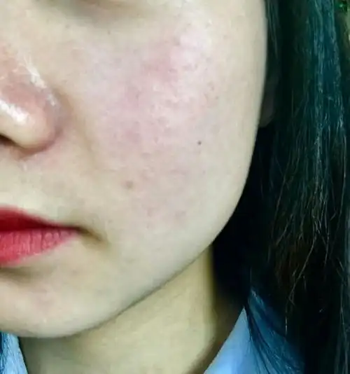 敏感红血丝肌肤有什么护肤品化妆品推荐呢