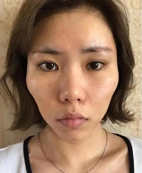 面部脂肪填充案例