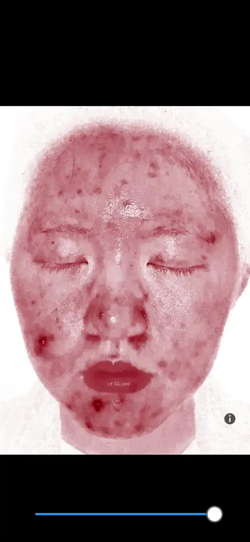 慎入面部炎症皮肤屏障受损