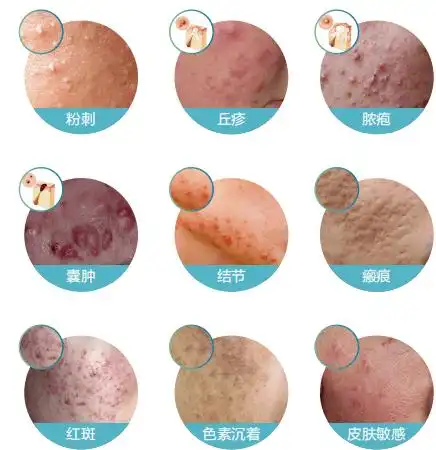 美肤科普丨一次说清楚关于痤疮那些事_皮肤_患者_毛囊
