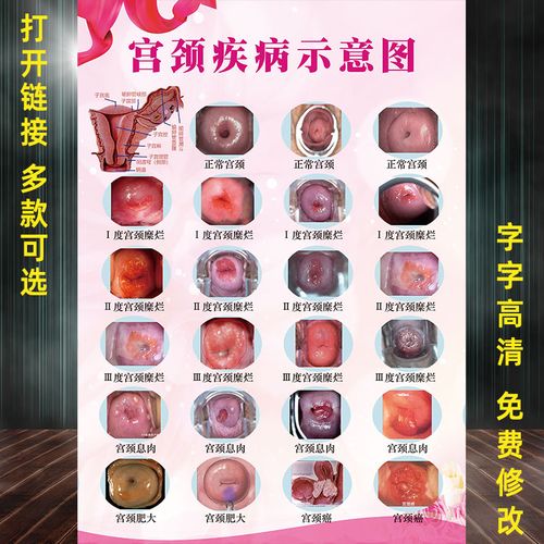 宫颈疾病示意图妇科门诊宣传海报病变级别挂图私密炎症子宫解剖图