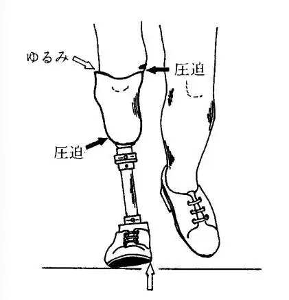 假肢穿戴舒服的三要素:接受腔,对线,康复训练