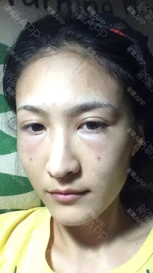 自体脂肪填泪沟手术后,一些受术者会经历一_圈子-新氧美容整形