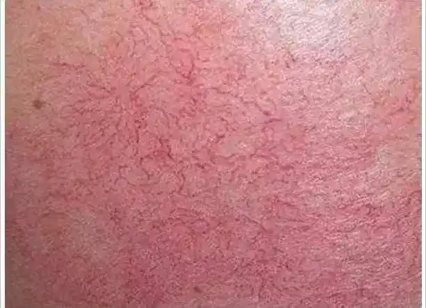 反复发作,为什么你脸上的红血丝就是好不了?