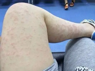 身上一片一片的红疙瘩,很痒,是怎么回事,是过敏了吗
