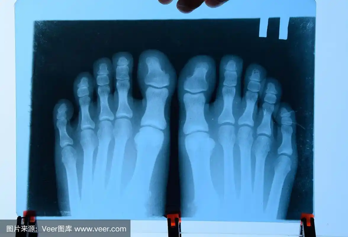 x射线的脚趾.在x光脚.骨的研究