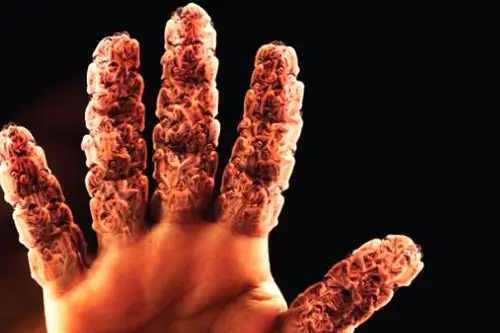 不容忽视的3个痛风并发症 - 简书