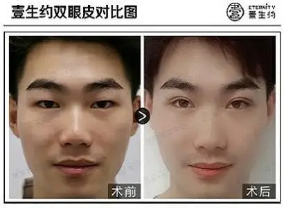 男士割双眼皮选择哪种方式比较好?一生约