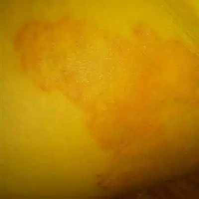 凡由致病性真菌侵犯腹股沟内侧所致环状或半环状皮损者统称为股癣