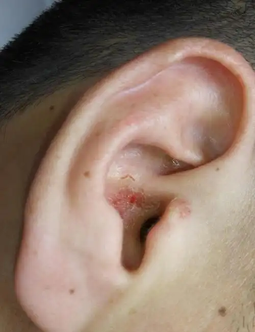 外耳道生疮结痂渗液