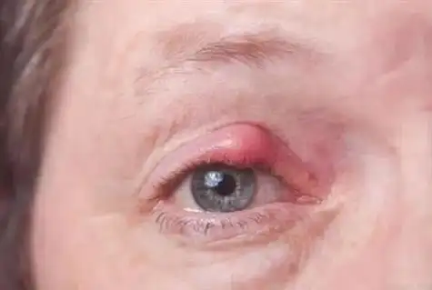 睑板腺囊肿手术后图片 - 搜狗图片搜索