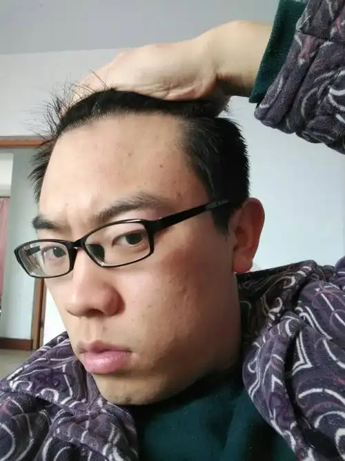 最近一段时间好像感觉右边鬓角上面缺一块.不知道继续发展会不会秃了.