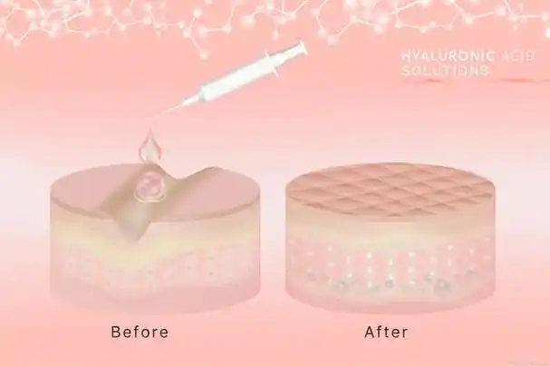 玻尿酸导入的作用你知道吗?以有效地保湿皮肤!