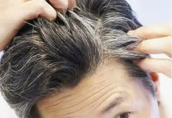 导致白发的原因有哪些引起白发的原因