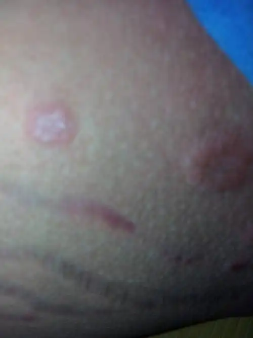 曾庆煜 医师 股藓差不多四个月了,以前大腿旁边的好了现在到睾丸那