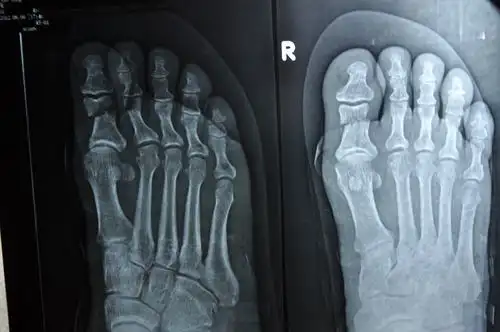 问题:右脚大脚趾骨折,多久可以恢复