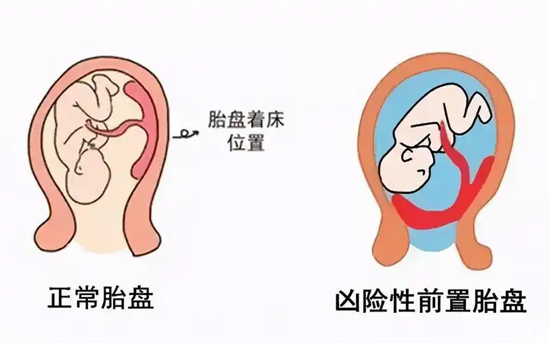 凶险性前置胎盘