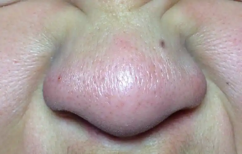 这鼻子上的黑毛孔点点怎么去除啊?专业点!!_百度知道