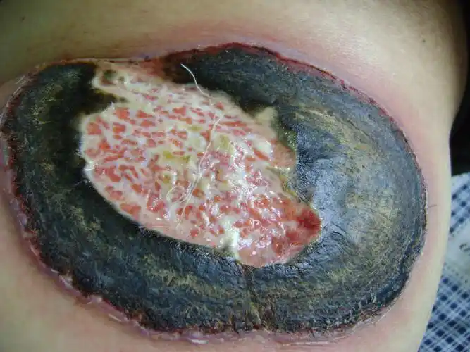 糖尿病皮肤溃疡病案