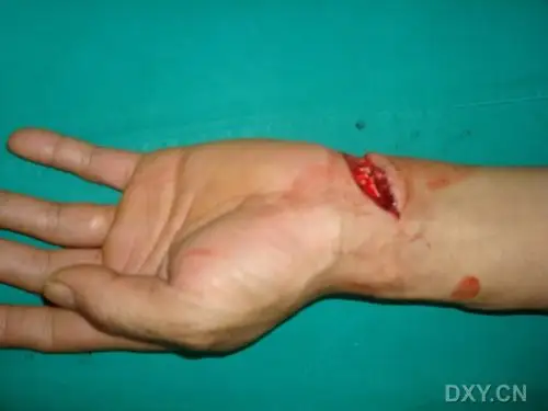 腕部切割伤