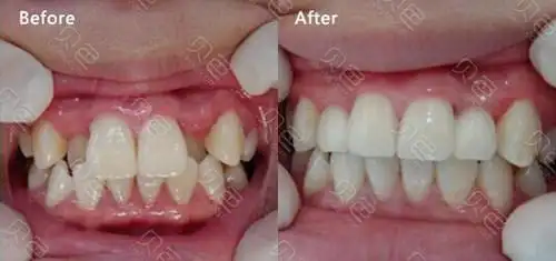 牙齿矫正需要拔牙吗?尤其是虎牙的矫正