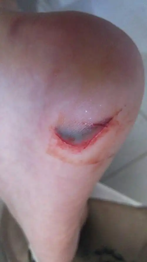 脚今天早上被划了 需要怎么处理 还要注意些什么?