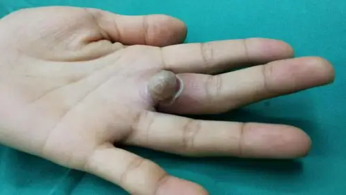 益阳一女子手掌长出肿块 几天就从绿豆变成花生大