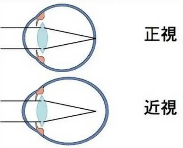 而只能 成像在视网膜之前时,近视就发生了