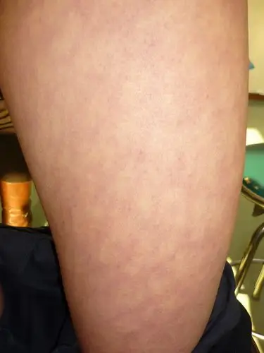 皮肤病病例图片分享火激红斑