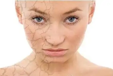 原来皮肤缺水才是罪魁祸首,皮肤干燥怎么办?